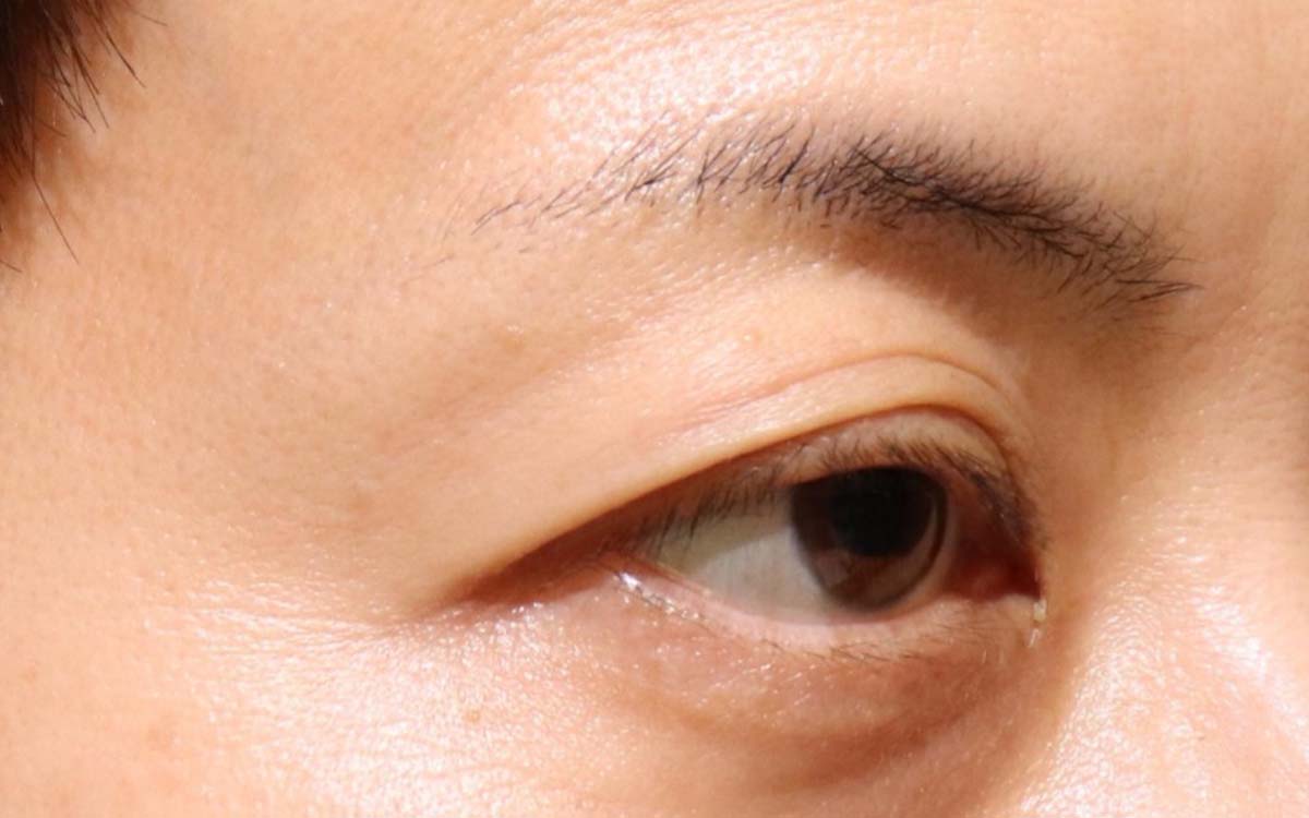 眼瞼下垂手術の症例 術前
