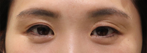 眼瞼下垂