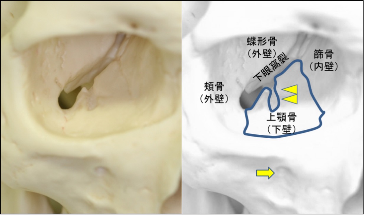 眼窩下壁のスケールモデル