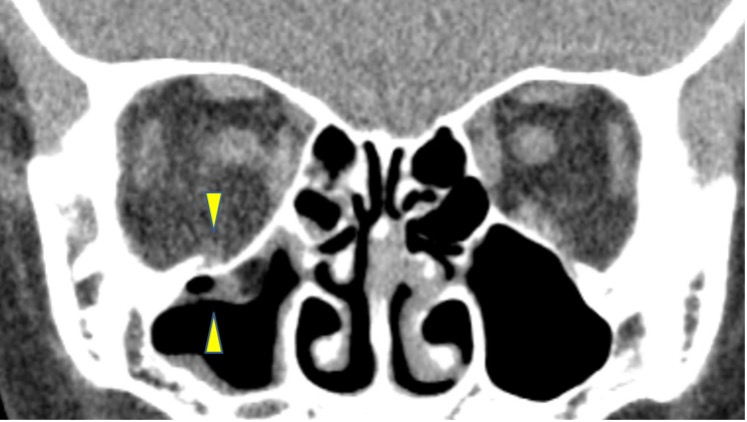 眼窩下壁骨折（閉鎖型）の冠状断CT