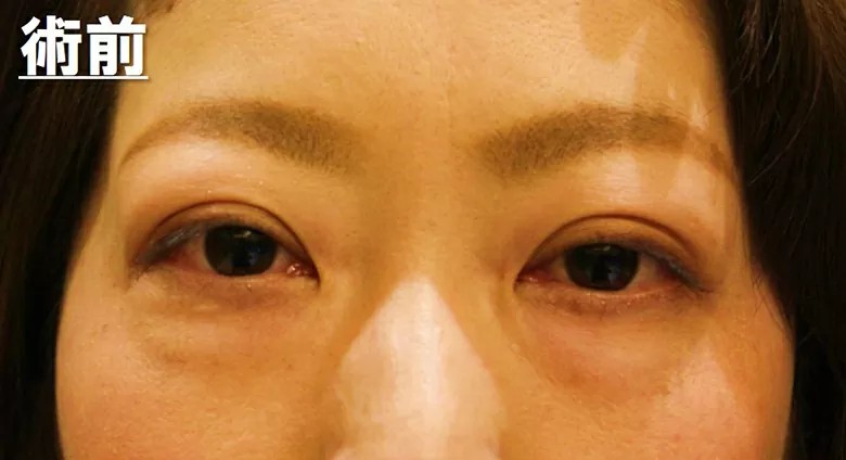 バセドウ病眼症