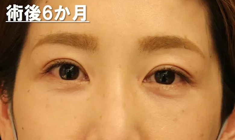 バセドウ病眼症