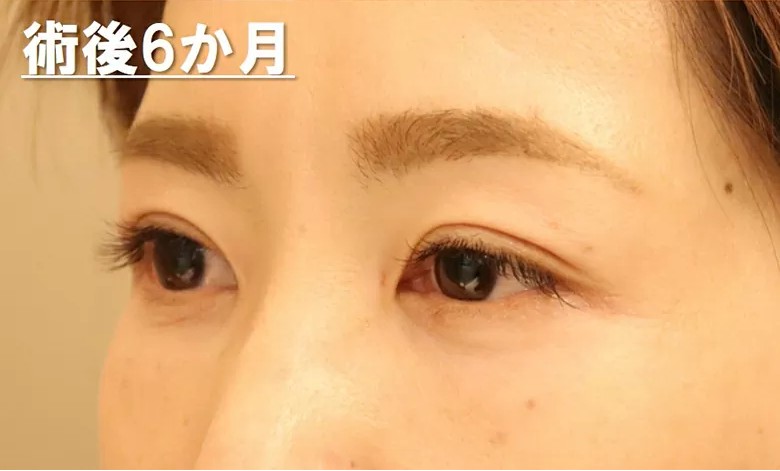 バセドウ病眼症