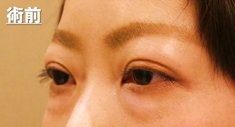 バセドウ病眼症