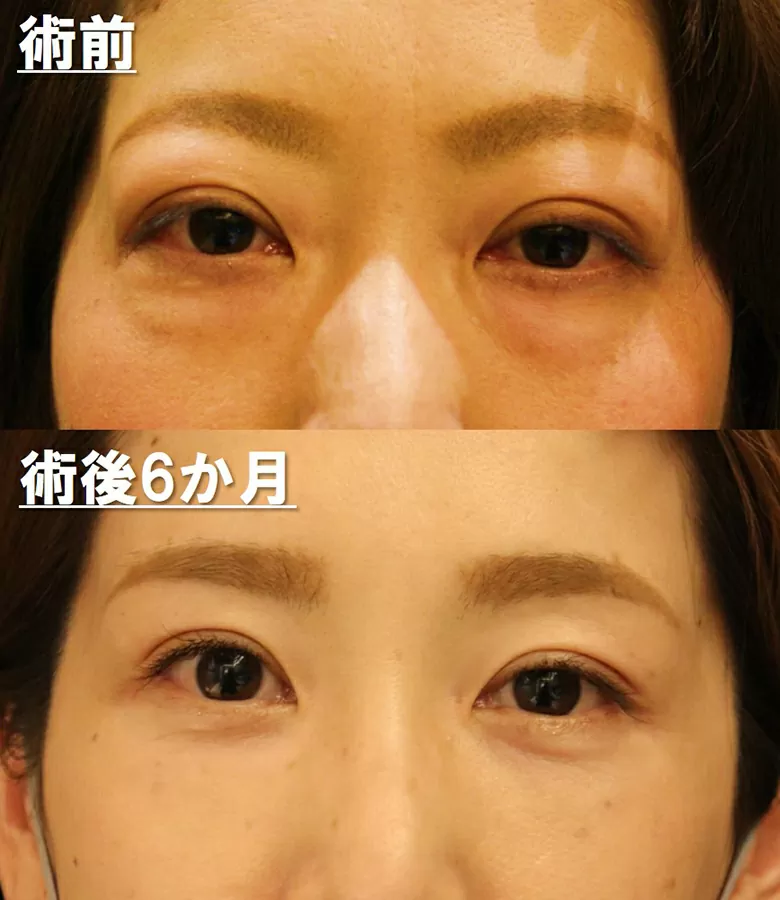 バセドウ病によるまぶたの腫れの特徴