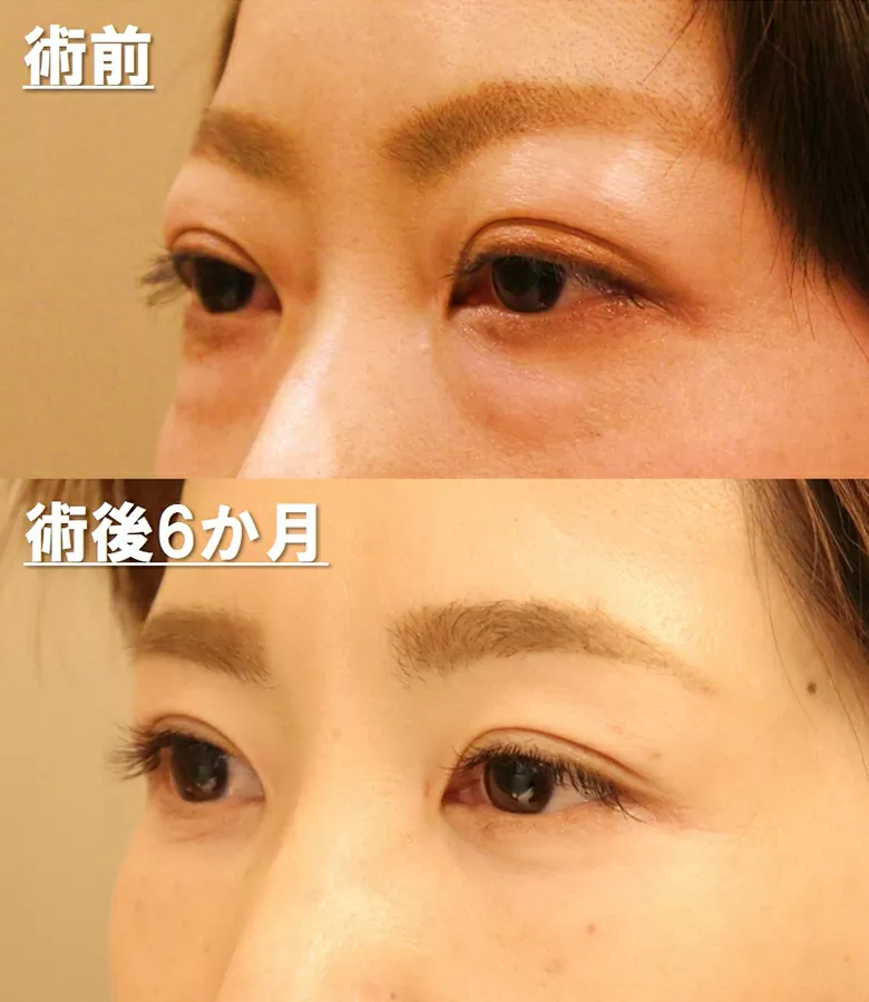 バセドウ病によるまぶたの腫れの特徴