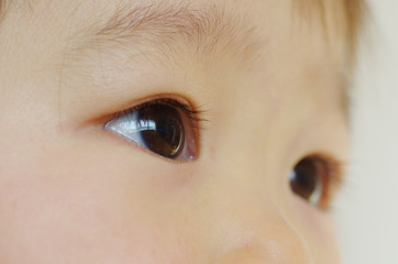 生まれつき眼瞼下垂の子供の特徴は?