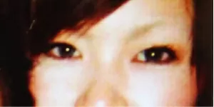 バセドウ病眼症