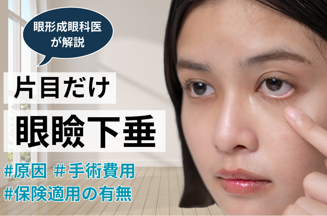 【片目だけの眼瞼下垂】原因や手術費用、保険適用の有無について眼形成眼科医が解説