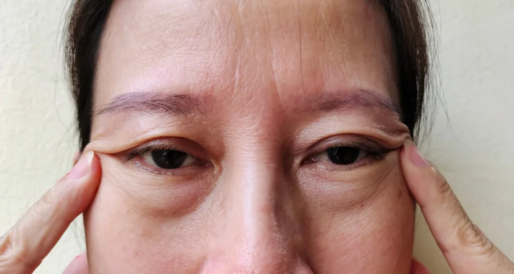 眼瞼下垂手術とは