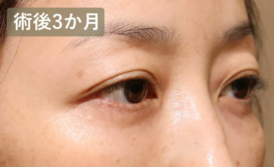 術後3ヶ月の状態