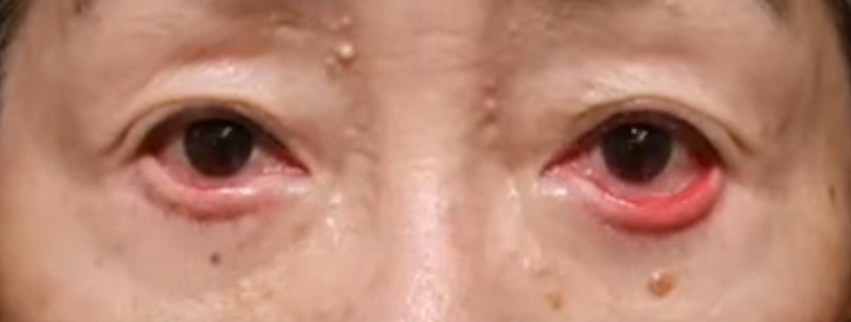 あっかんべー状態（目の下の赤い粘膜部分が露出）