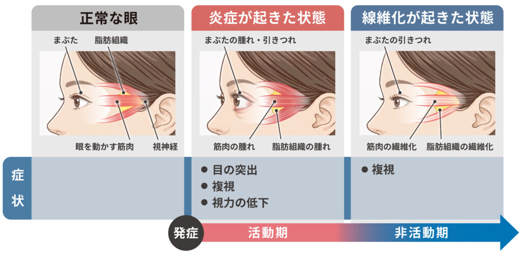 甲状腺眼症の症状の段階