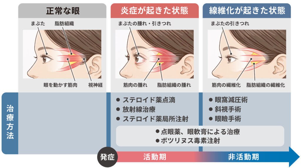 甲状腺眼症の経過と各時期の治療