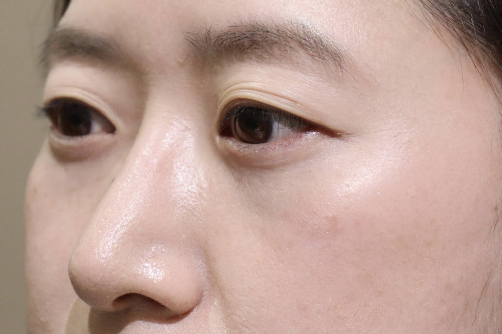 術後3か月　斜め