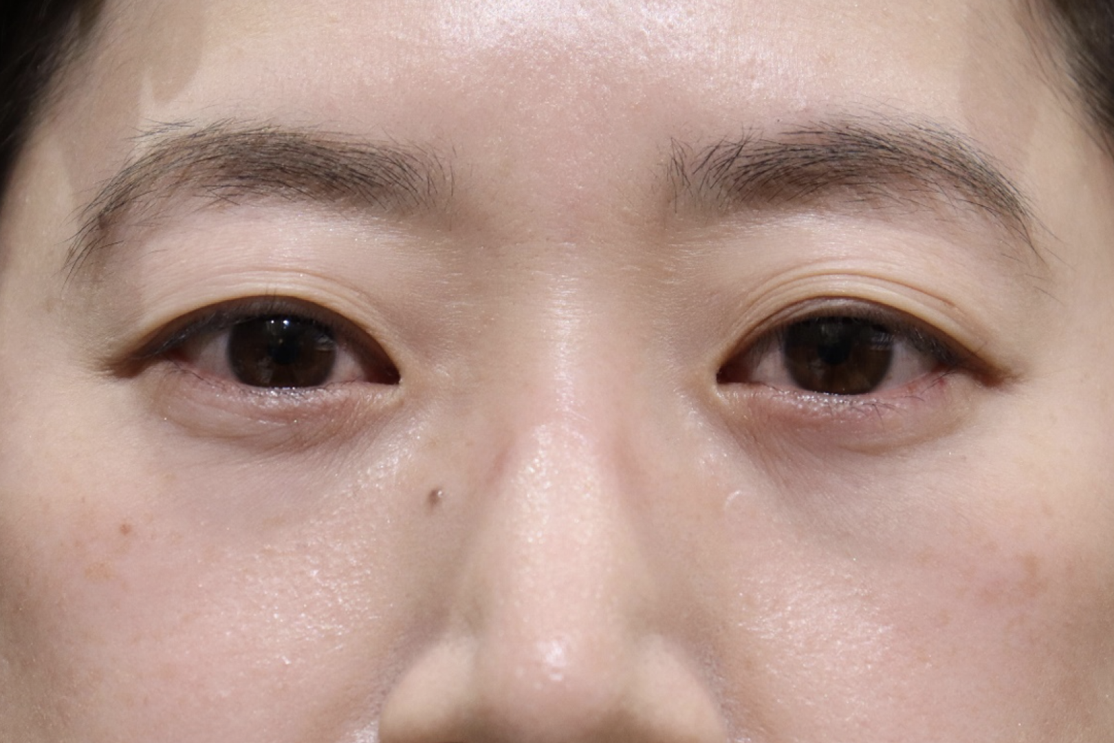 「眼窩減圧手術」　術後3か月　正面