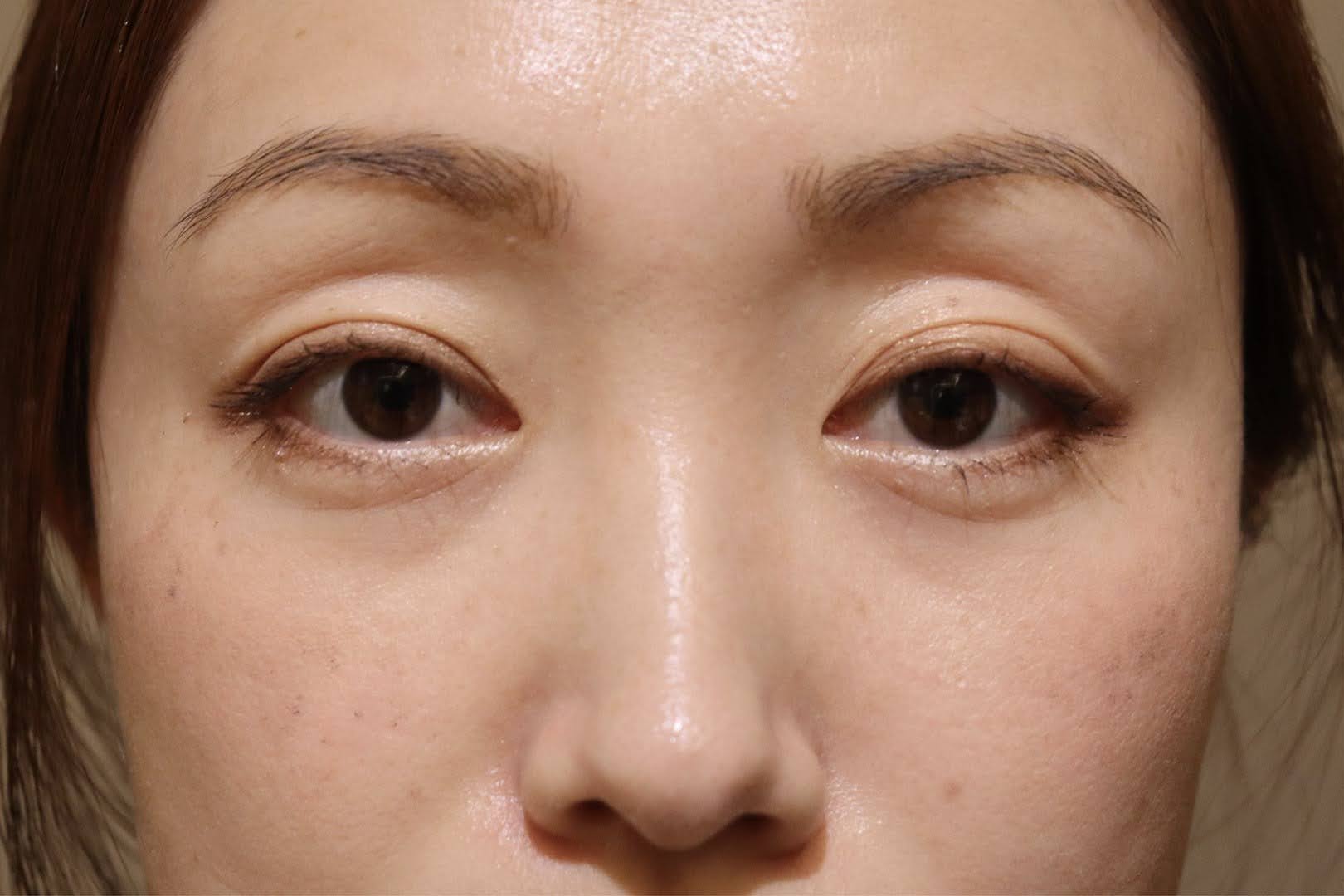 「眼窩減圧手術」術後3か月　正面