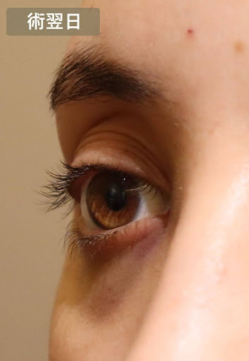 術翌日