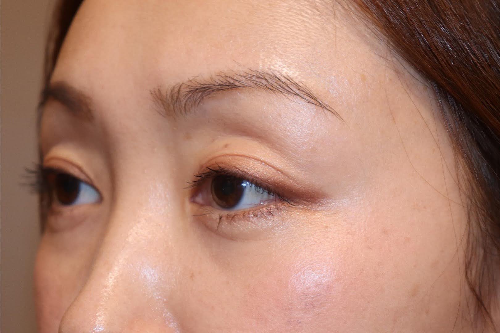 術後3か月　斜め