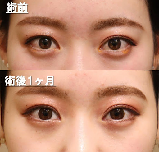 症例写真を用いて眼窩（がんか）減圧術を説明