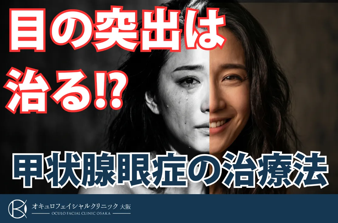 甲状腺眼症の治療法